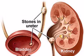 Thêm hy vọng cho bệnh nhân thận