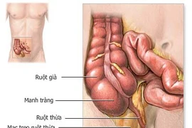 Kháng sinh an toàn và hiệu quả để điều trị viêm ruột thừa