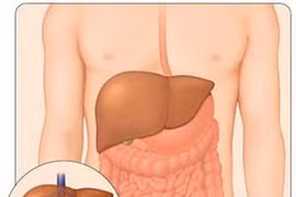 Mỹ: Tử vong do viêm gan C cao hơn HIV