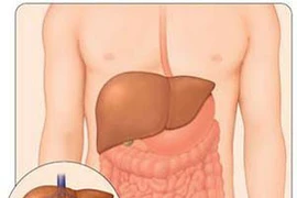 Mỹ: Tử vong do viêm gan C cao hơn HIV