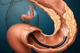 Người béo dễ bị pô-lýp đại tràng