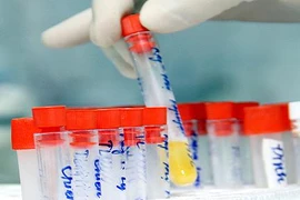 Đoán bệnh qua nước tiểu