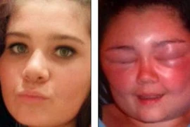 Biến dạng khuôn mặt vì thuốc nhuộm tóc