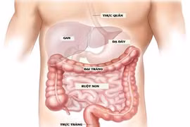 Xét nghiệm mới hỗ trợ phát hiện sớm ung thư đại tràng