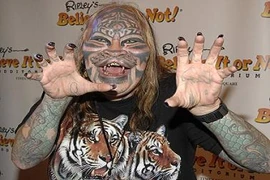 Người đàn ông “mặt hổ” đã qua đời