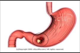 Nên đi khám ung thư dạ dày 3 năm/lần