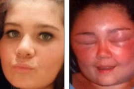 Biến dạng khuôn mặt vì thuốc nhuộm tóc