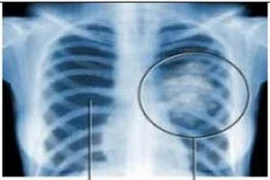 Sàng lọc ung thư phổi có lợi cho người nghiện thuốc lá