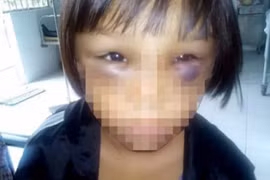 Nghi án bé gái 7 tuổi bị mẹ kế đánh đập, châm tàn thuốc lá vào lòng bàn tay