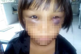 Nghi án bé gái 7 tuổi bị mẹ kế đánh đập, châm tàn thuốc lá vào lòng bàn tay