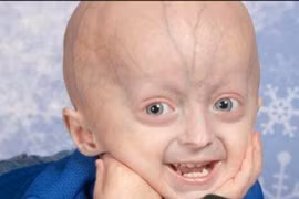 Pháp đã tìm ra hội chứng lão hóa sớm