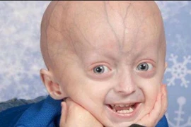 Pháp đã tìm ra hội chứng lão hóa sớm