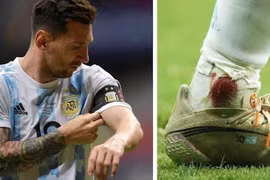 Sốc với hình ảnh cổ chân chảy máu của Messi ở bán kết Copa America