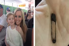 Phát hiện kim băng trong mũi bé 5 tuổi