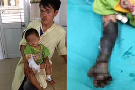 Cháu bé bị hoại tử cánh tay do cha mẹ đắp tro lên vết bỏng