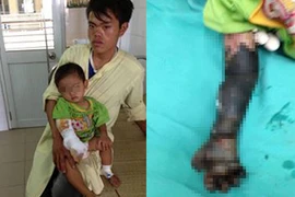 Cháu bé bị hoại tử cánh tay do cha mẹ đắp tro lên vết bỏng