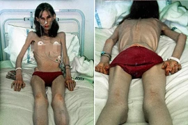 Nhịn ăn mong trẻ mãi, ai ngờ biến thành "bộ xương di động"