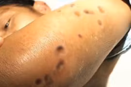 41 người chết, 1.500 người bị thương vì bị ong bắp cày đốt