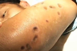 41 người chết, 1.500 người bị thương vì bị ong bắp cày đốt