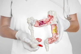 Ngăn chặn nguy cơ ung thư từ bệnh tiêu hóa 
