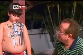 Cậu bé hút chặt kim loại trên cơ thể