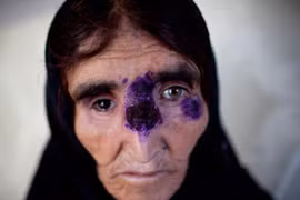 Virus ăn thịt người có thể "đổ bộ" vào châu Âu