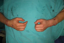 Nối thành công 2 cánh tay bị chém đứt lìa sau 5 giờ