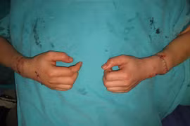 Nối thành công 2 cánh tay bị chém đứt lìa sau 5 giờ