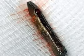 Sống sót dù đinh đâm vào tim