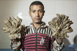 Khốn khổ vì mục cóc biến thành "rễ cây" trên cơ thể 