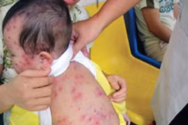 Cập nhật kỹ thuật chẩn đoán sớm giúp phát hiện 80 bệnh tự miễn, dị ứng