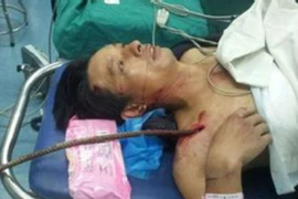 Sống sót dù thanh sắt xuyên qua ngực