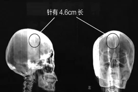 Kim khâu hơn 4cm nằm trong đầu gần nửa đời người mà không hay biết