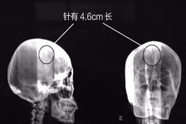 Kim khâu hơn 4cm nằm trong đầu gần nửa đời người mà không hay biết