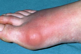 Cách ăn uống đề phòng bệnh gút