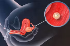 Sản xuất tinh trùng trong ống nghiệm