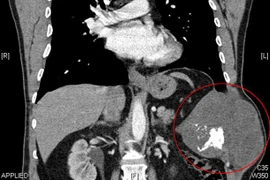 Sống sót sau cuộc phẫu thuật "vá ngực" bằng... xi măng