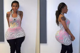 Bắt giữ bác sĩ rởm bơm mông bằng những hợp chất quái dị