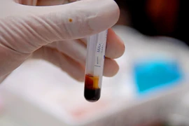 Xét nghiệm máu cho thấy triển vọng phát hiện sớm ung thư tuyến tụy