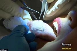 Giảm 9kg trong vòng 30 ngày nhờ khâu gạc vào lưỡi