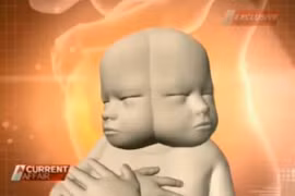  Bào thai có 2 khuôn mặt và 2 bộ não dính liền