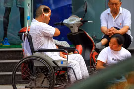 Phi thường người đàn ông sống với lỗ hổng trên đầu