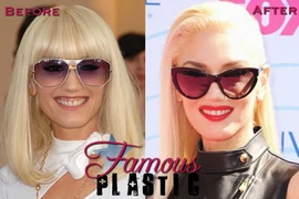 Nghi án Gwen Stefani đụng dao kéo