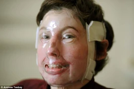 Sống sót thần kì sau khi bị bỏng 96% cơ thể 