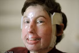 Sống sót thần kì sau khi bị bỏng 96% cơ thể 