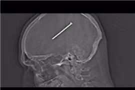 Sống với chiếc đinh dài gần 9 cm găm trong não