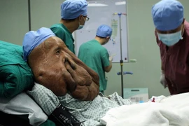 Người đàn ông khổ sở với khối u 17.5 kg trên mặt