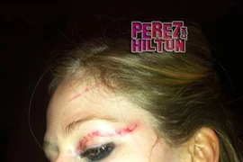 Hé lộ bức ảnh về thương tích của Avril sau ẩu đả