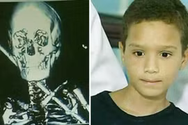 Vẫn sống sót dù bị thanh sắt 60 cm đâm xuyên người 