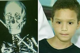 Vẫn sống sót dù bị thanh sắt 60 cm đâm xuyên người 